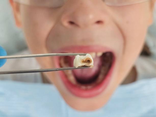 Best Emergency Wisdom Teeth Removal in Hanscom Af, MA